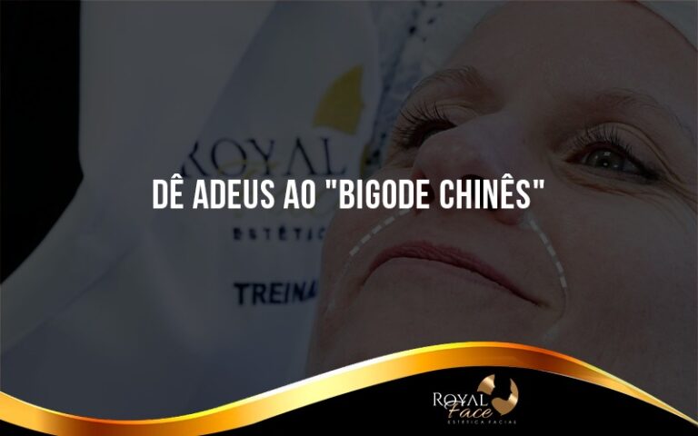 Como acabar com o bigode chinês: saiba como tratar as rugas ao redor dos lábios