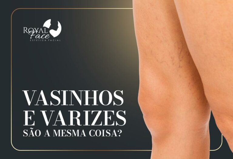 Qual a diferença entre vasinhos e varizes?