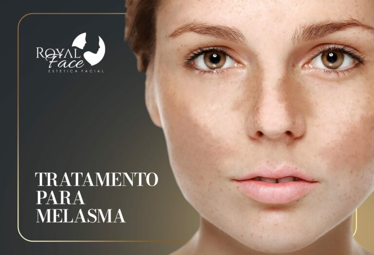 Qual o melhor tratamento para melasma?
