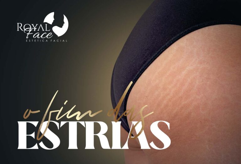 Estrias: quais os tipos e como tratar?