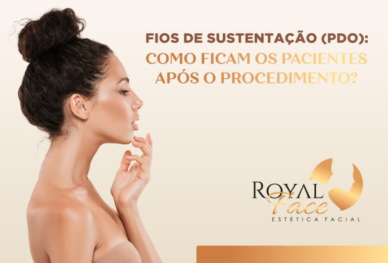 Fios de sustentação (PDO): como ficam os pacientes após o procedimento?