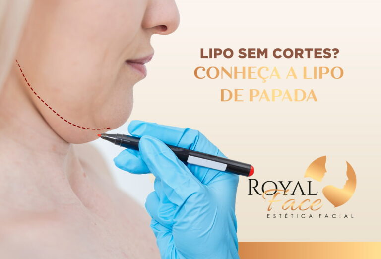 Lipo sem cortes? Conheça a Lipo de Papada!