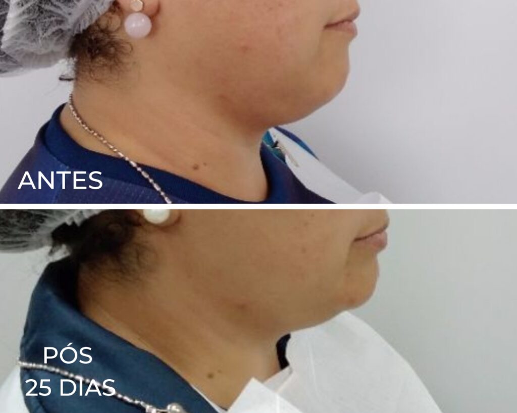 Antes e depois da Lipo de Papada - Royal Face