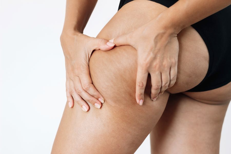 Redução da celulite é um dos benefícios da carboxiterapia corporal: mulher apertando a pele para encontrar celulites