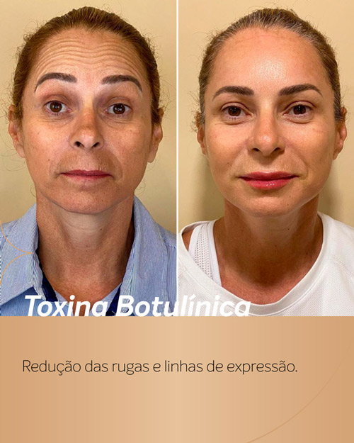 Antes e depois do Botox para redução de linhas e rugas, resultados naturais e bonitos.