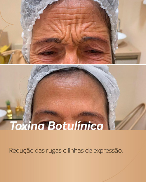 Antes e depois Botox na testa