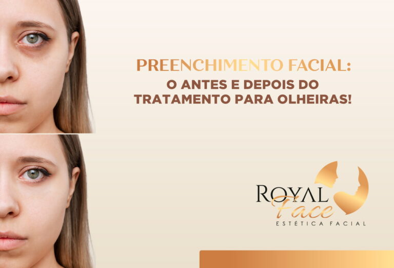 Preenchimento facial: antes e depois do tratamento para olheiras