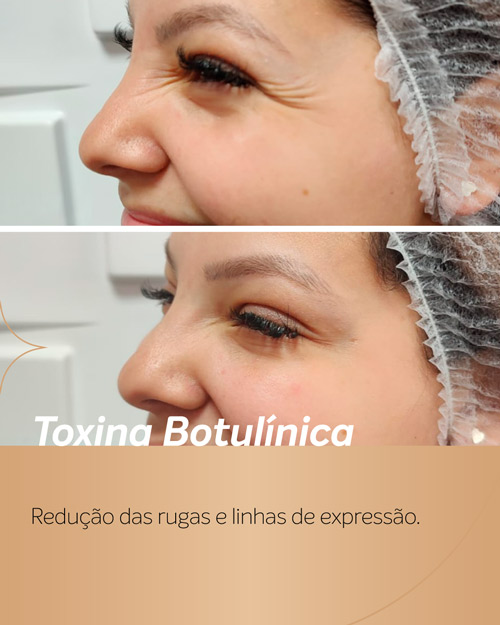 Antes e depois da aplicação de Botox nos pés de galinha, resultados naturais.