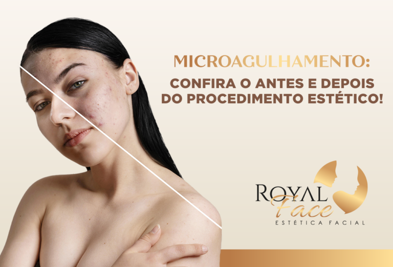 Microagulhamento: confira o antes e o depois do procedimento