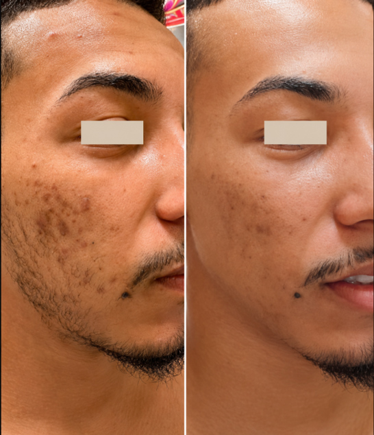 (Antes e depois do microagulhamento para cicatrizes de acne na bochecha com melhora da textura da pele e suavização das marcas de acne)