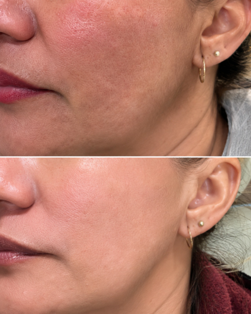 Antes e depois do microagulhamento facial para melhora da textura da pele, com poros menos aparentes, pele mais uniforme e aspecto mais viçoso na região da bochecha.