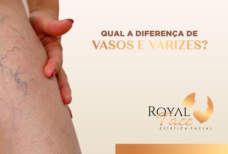 Qual a diferença de vasos e varizes?