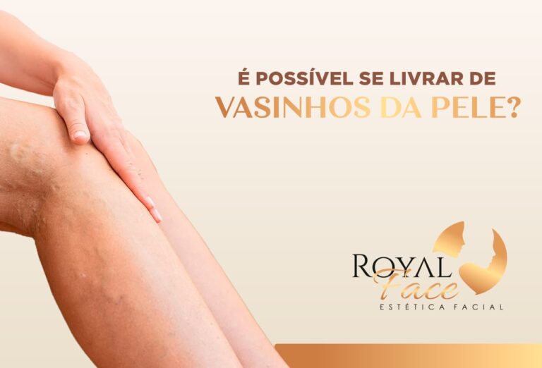 É possível se livrar dos vasinhos da pele?