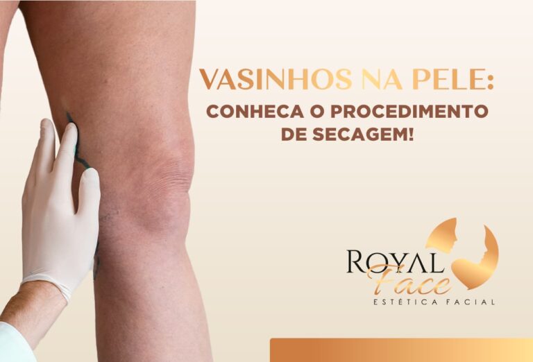 Vasinhos na pele: conheça o procedimento de secagem!