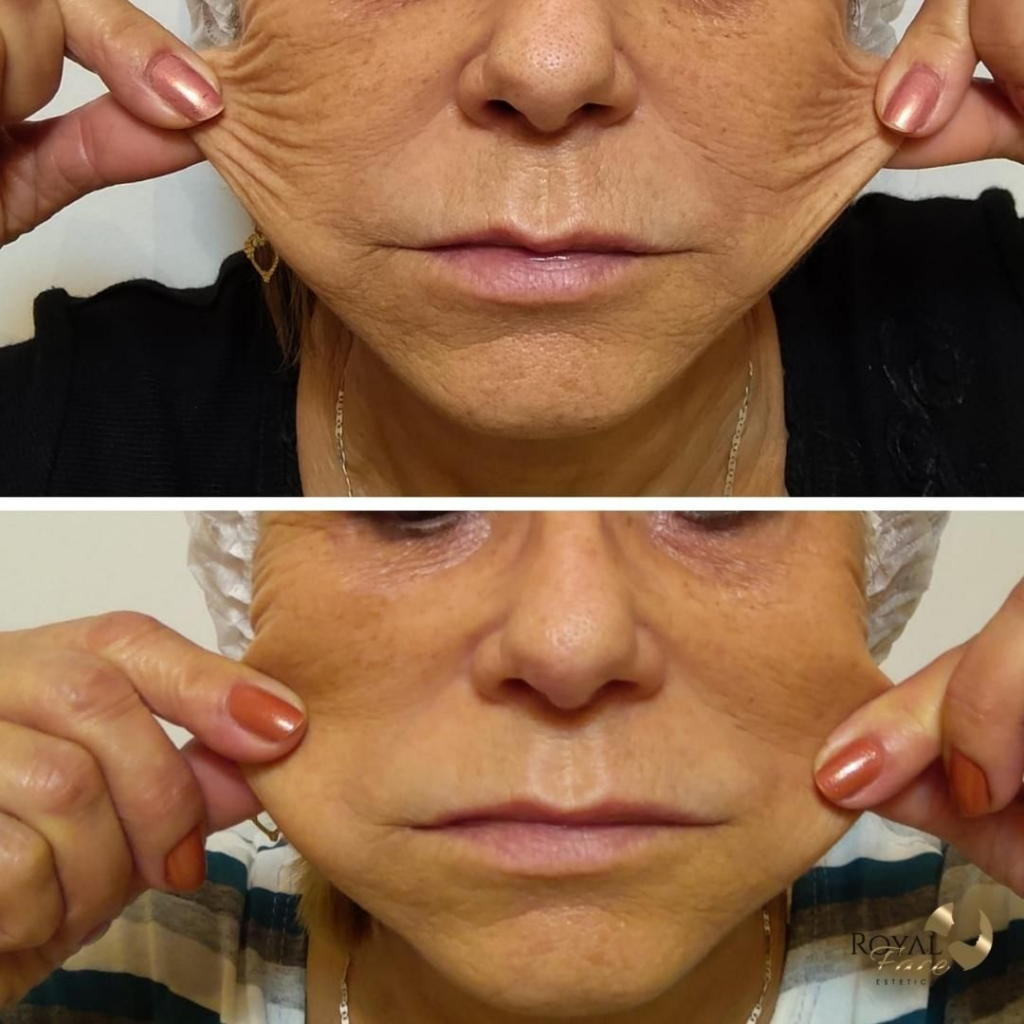 Bioestimulador de colágeno - Royal Face | Clínica de Estética