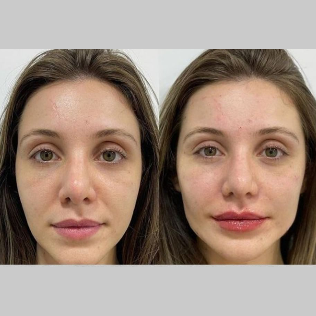 resultado harmonização facial