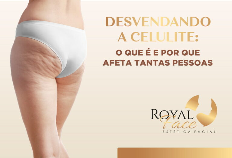 Desvendando a celulite: O que é e por que afeta tantas pessoas