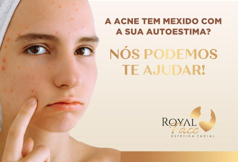 A Acne tem mexido com a sua autoestima? Podemos te ajudar!