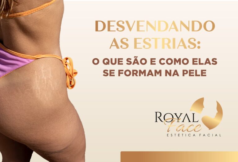 Desvendando as estrias: O que são e como elas se formam na pele