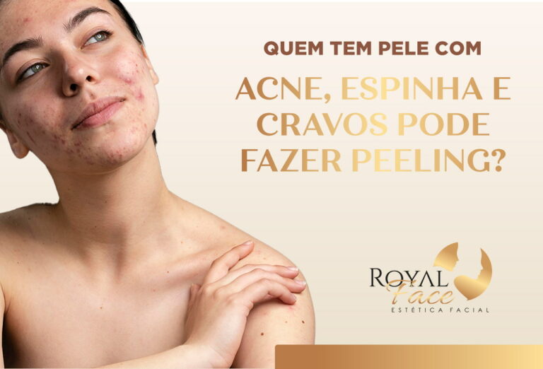 Quem tem pele com acne, espinha e cravos pode fazer peeling?