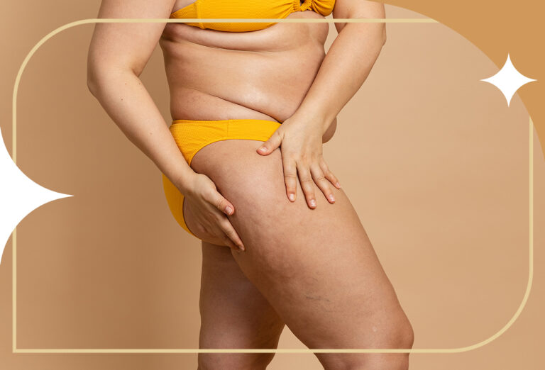 Celulite: causas, graus e os tratamentos mais eficazes para cada caso