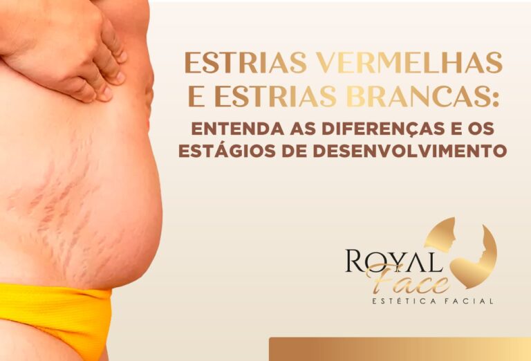 Estrias vermelhas e estrias brancas: Entenda as diferenças e os estágios de desenvolvimento