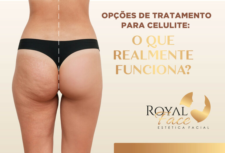 Opções de tratamento para celulite: O que realmente funciona?