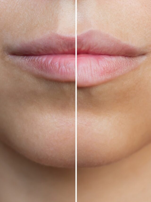 Avaliando os resultados: Antes e depois do preenchimento labial