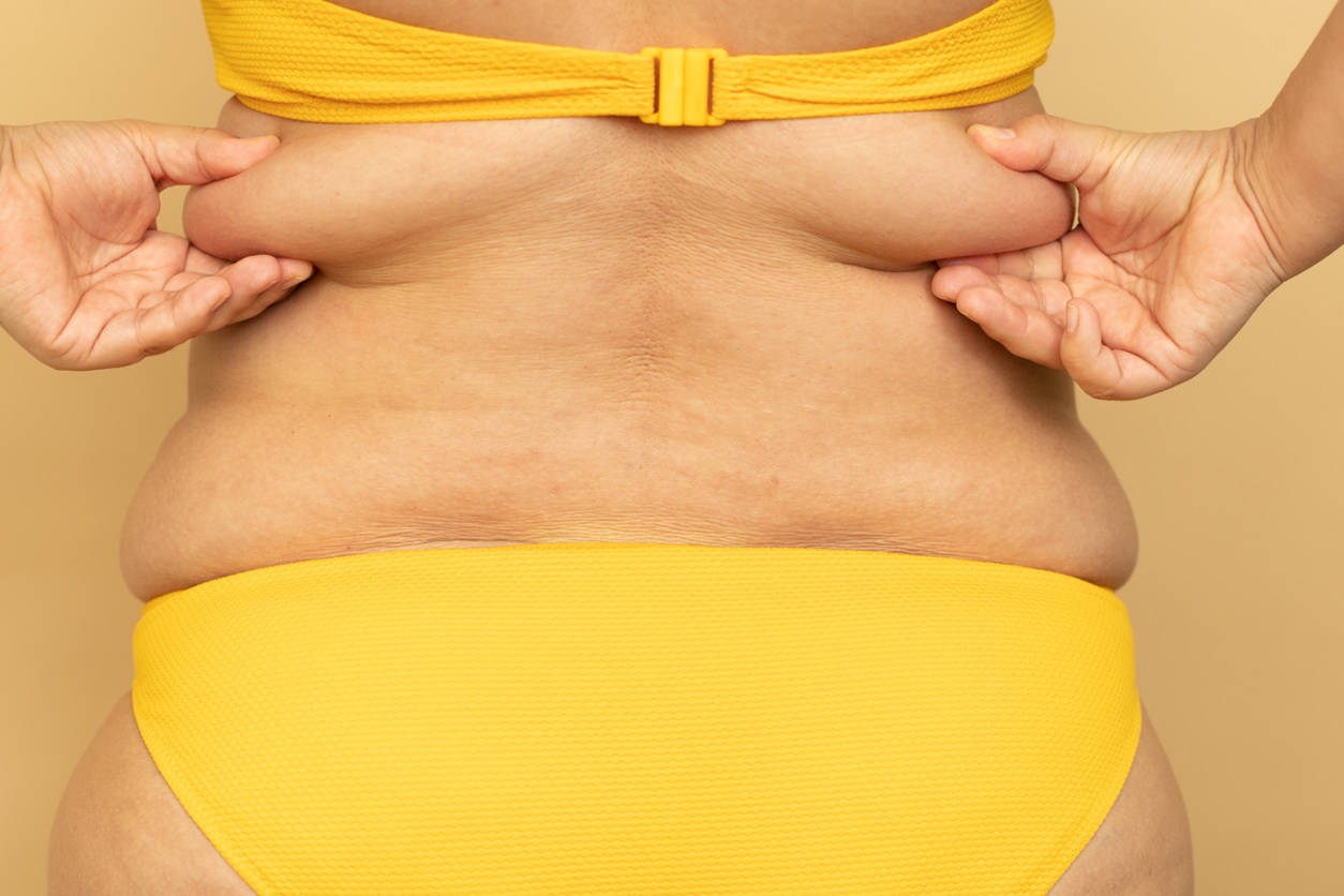 A complexidade da gordura localizada