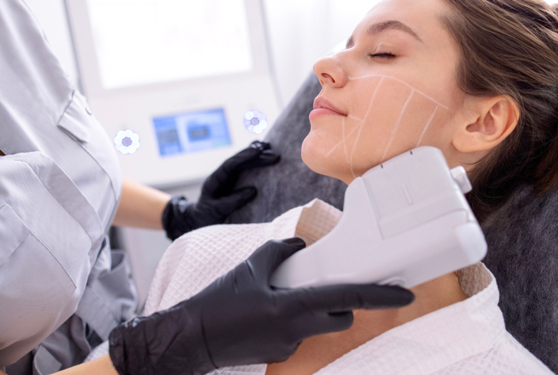 Mulher com rosto marcado para realização de procedimento de ultrassom microfocado.