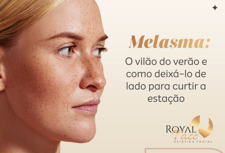 Melasma: O vilão do verão e como deixá-lo de lado para curtir a estação