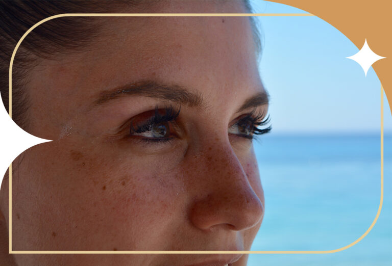 Manchas no Verão: Identifique, Cuide e Revele uma Pele Radiante!