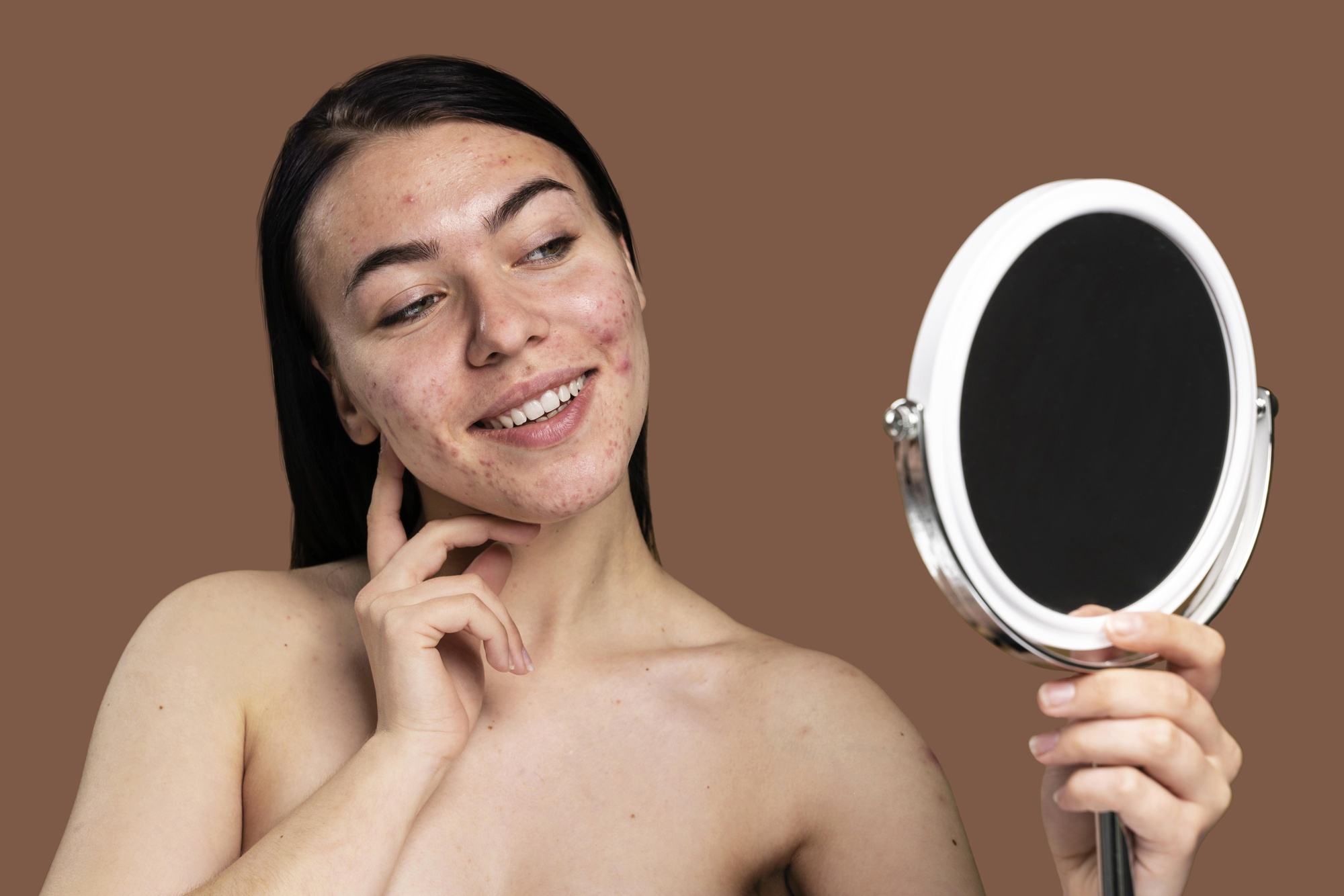 Como a Royal Face Te Ajuda A Dizer Adeus, Acne! (1)