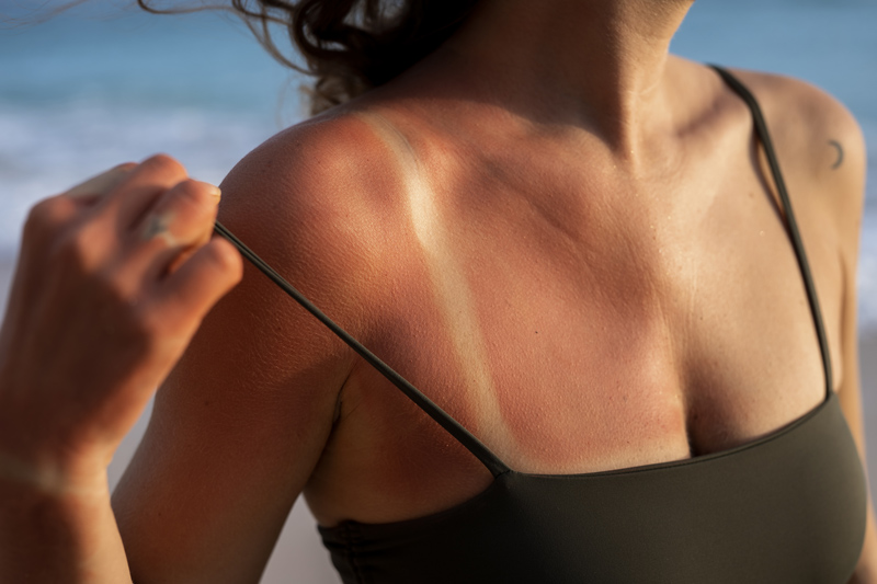 Mulher com pele avermelhada, queimada de sol e com marca de bikíni. Pele fototipo II ou III, que queima pouco mas bronzeia.
