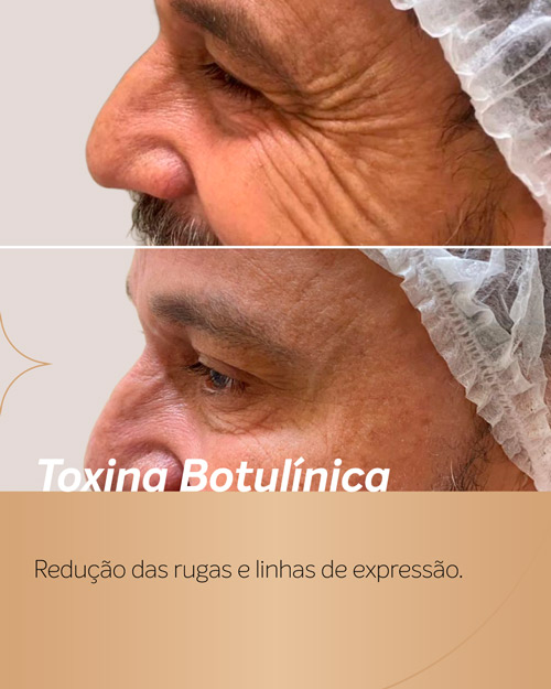 Antes e depois de botox masculino na região dos pés de galinha, com visível melhora no aspecto. Procedimento realizado na Royal Face.