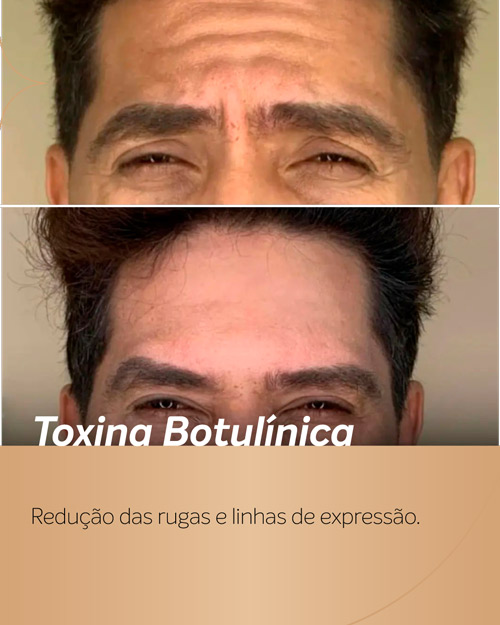 Botox para homem realizado na região da testa, com visível suavização das rugas. Realizado pela Royal Face.