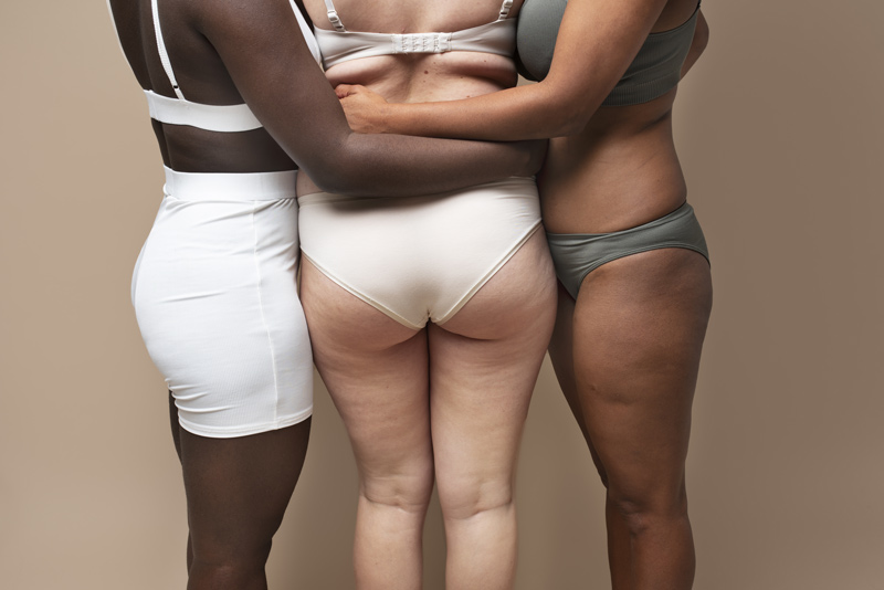 Corpos femininos da cintura para baixo, mostrando o bumbum, são mulheres querendo realizando procedimentos estéticos para glúteos.