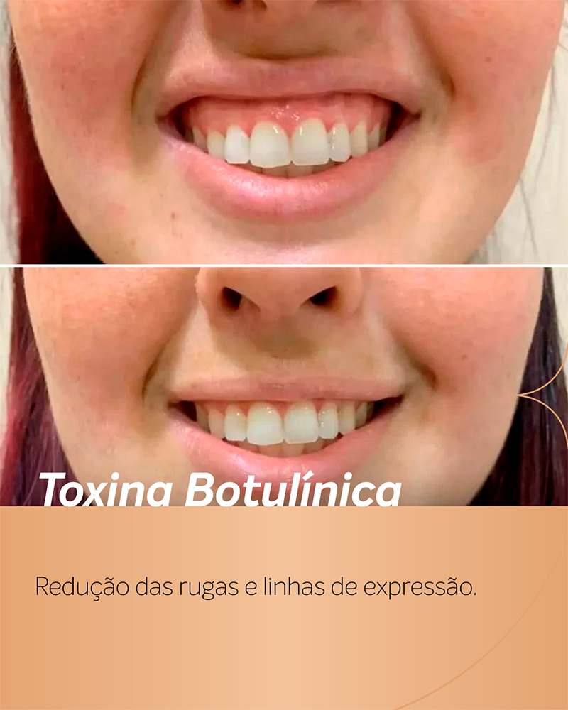Antes-e-depois-botox-sorriso-gengival