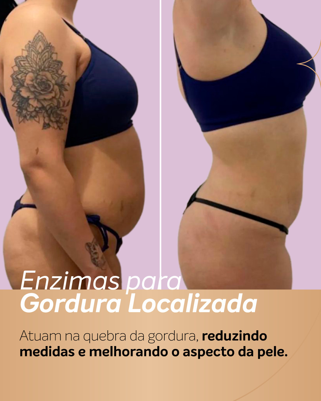Antes e depois da aplicação de enzimas na barriga em paciente com maior volume abdominal, mostrando redução de medidas e melhora do contorno corporal.