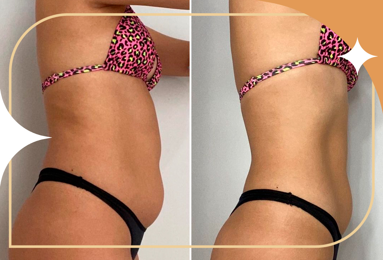 aplicação de Enzimas na barriga antes e depois: vista de perfil