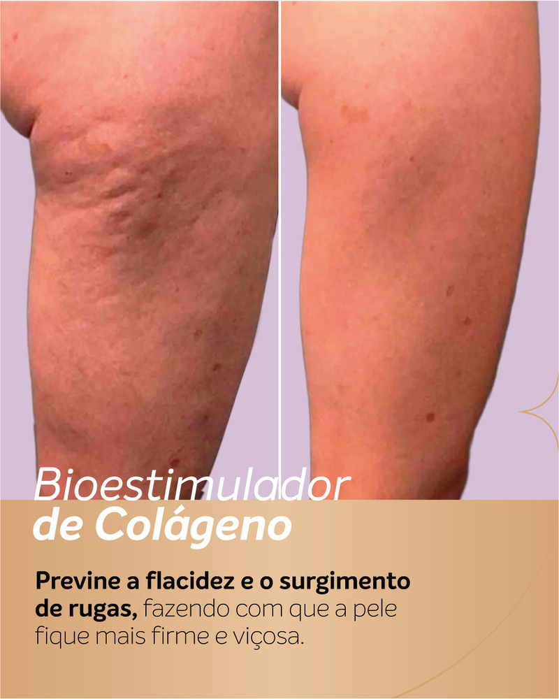 Antes e depois do bioestimulador de colágeno na coxa, mostrando melhora da firmeza e da textura da pele