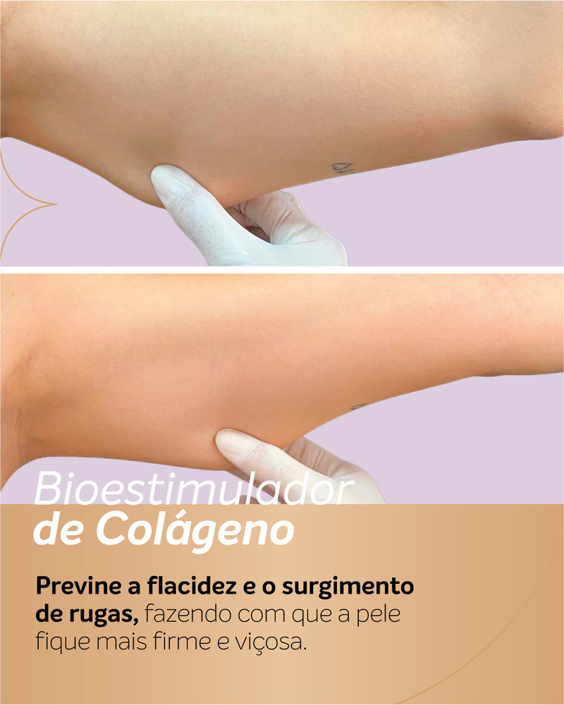 Antes e depois de bioestimulador de colágeno em área com flacidez no braço, demonstrado por meio de um teste de pinçamento da pele