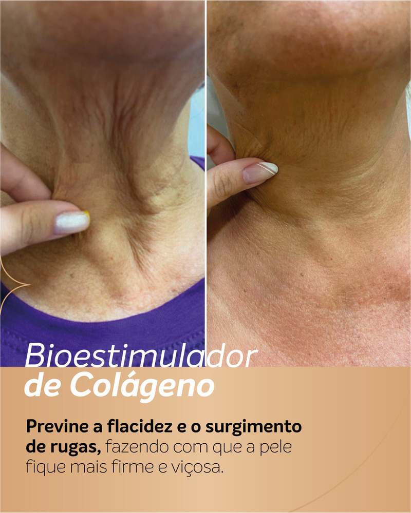 Antes e depois de bioestimulador de colágeno na região do pescoço, com teste manual de firmeza da pele