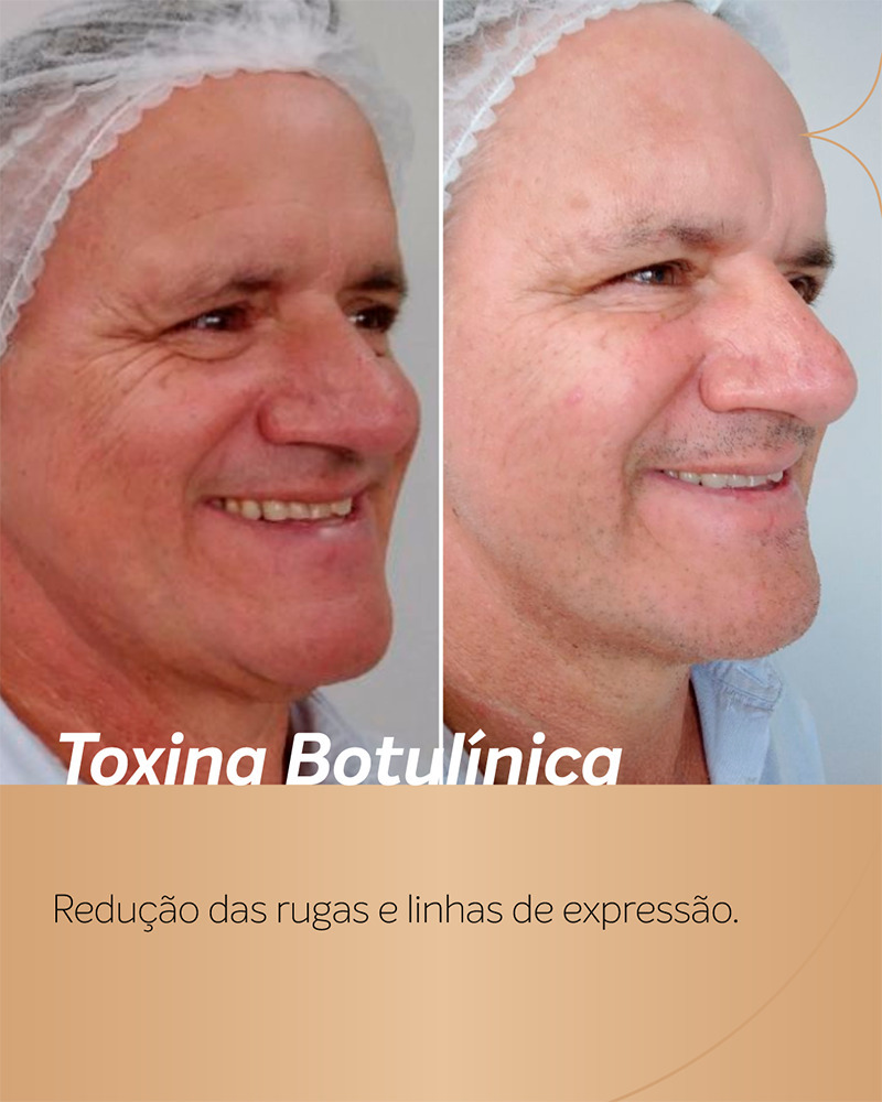 antes e depois botox em rosto de homem de perfil