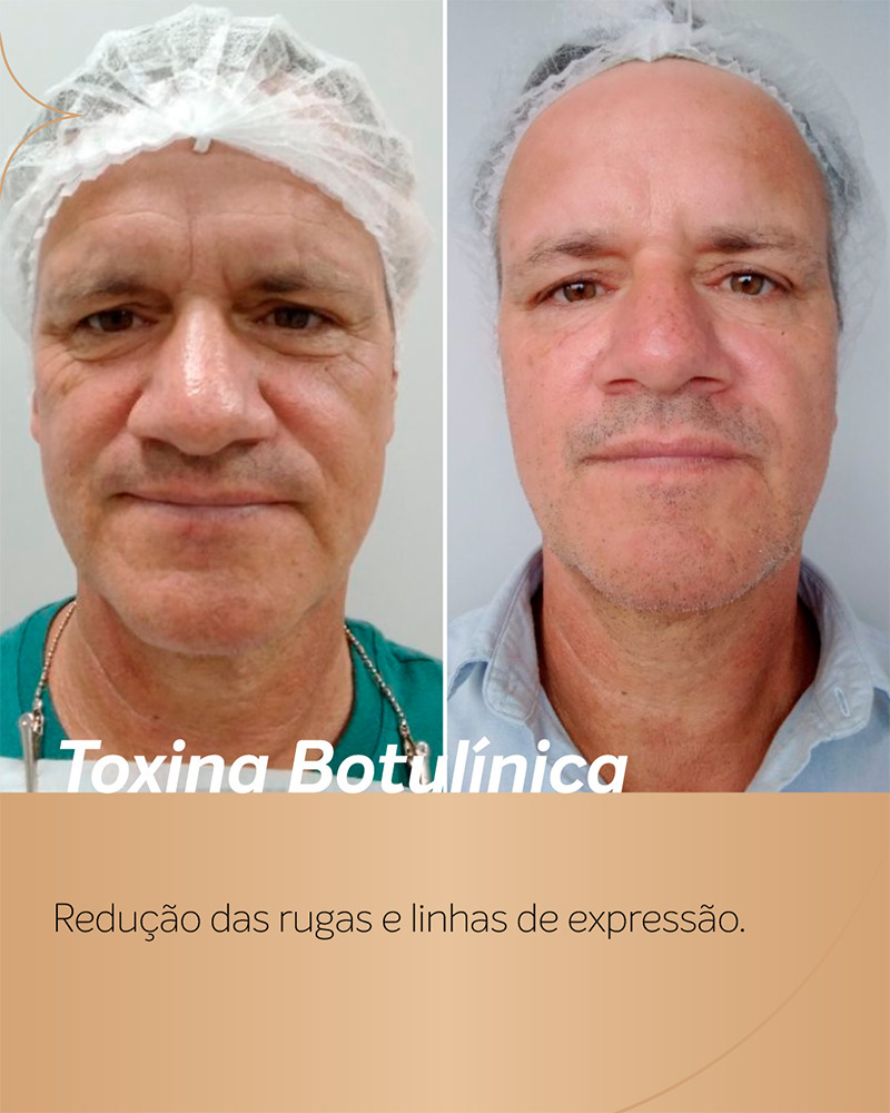 antes e depois botox masculino de frente