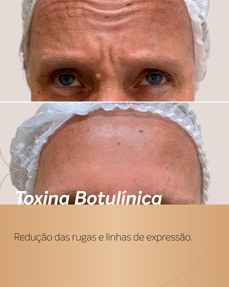 antes e depois botox para homem na testa