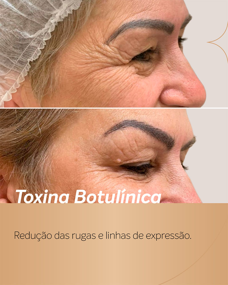 antes e depois botox pés de galinha