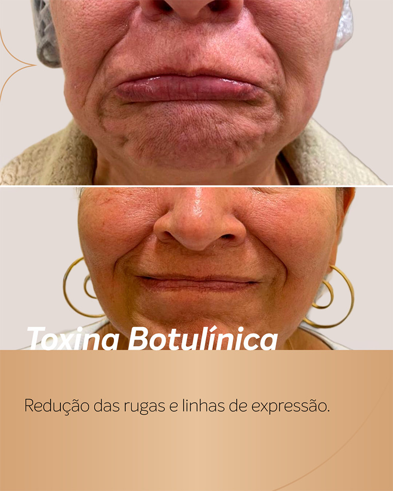antes e depois botox região da boca