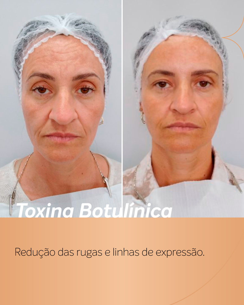 antes-e-depois-botox-rosto-feminino