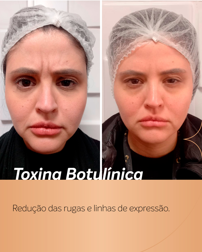 antes e depois botox rosto feminino mais jovem